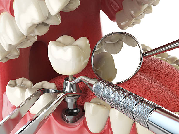 Emergency Treatment for Gum Disease